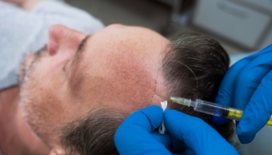 hair transplant