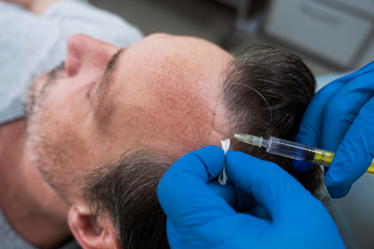 Top 10 Hair Transplant Clinics in Delhi NCR, India (2023) Top 10 Hair Transplant Clinics in Delhi NCR, India (2023)